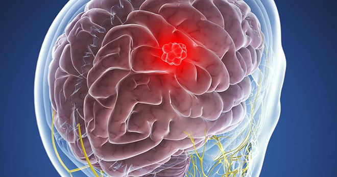 Российские ученые научились диагностировать опухоль головного мозга со 100% точностью