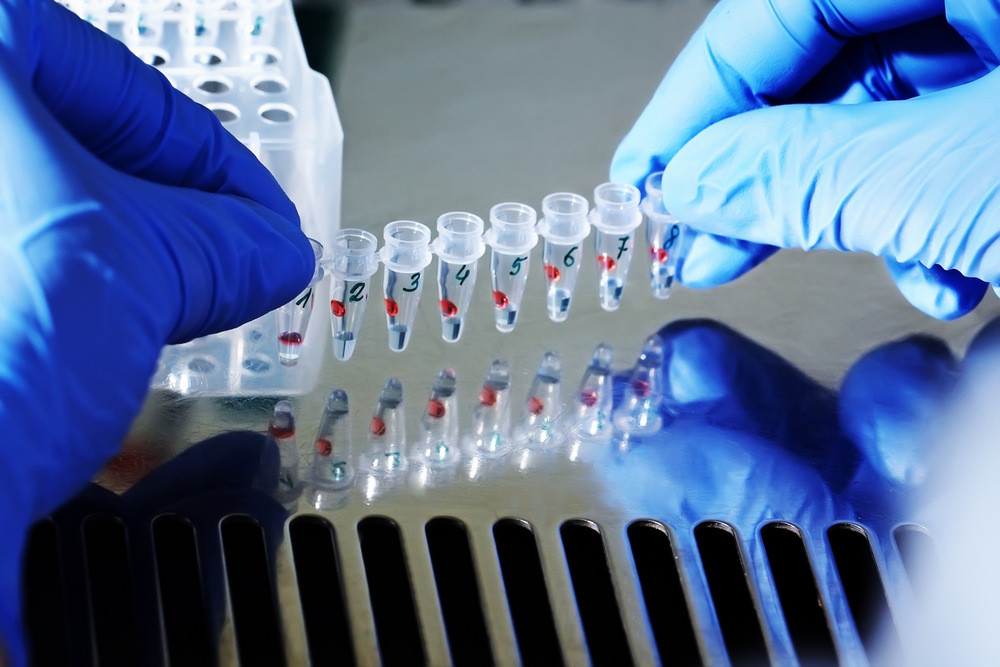 Российские ученые разработали тест-систему для выявления редкого генетического заболевания